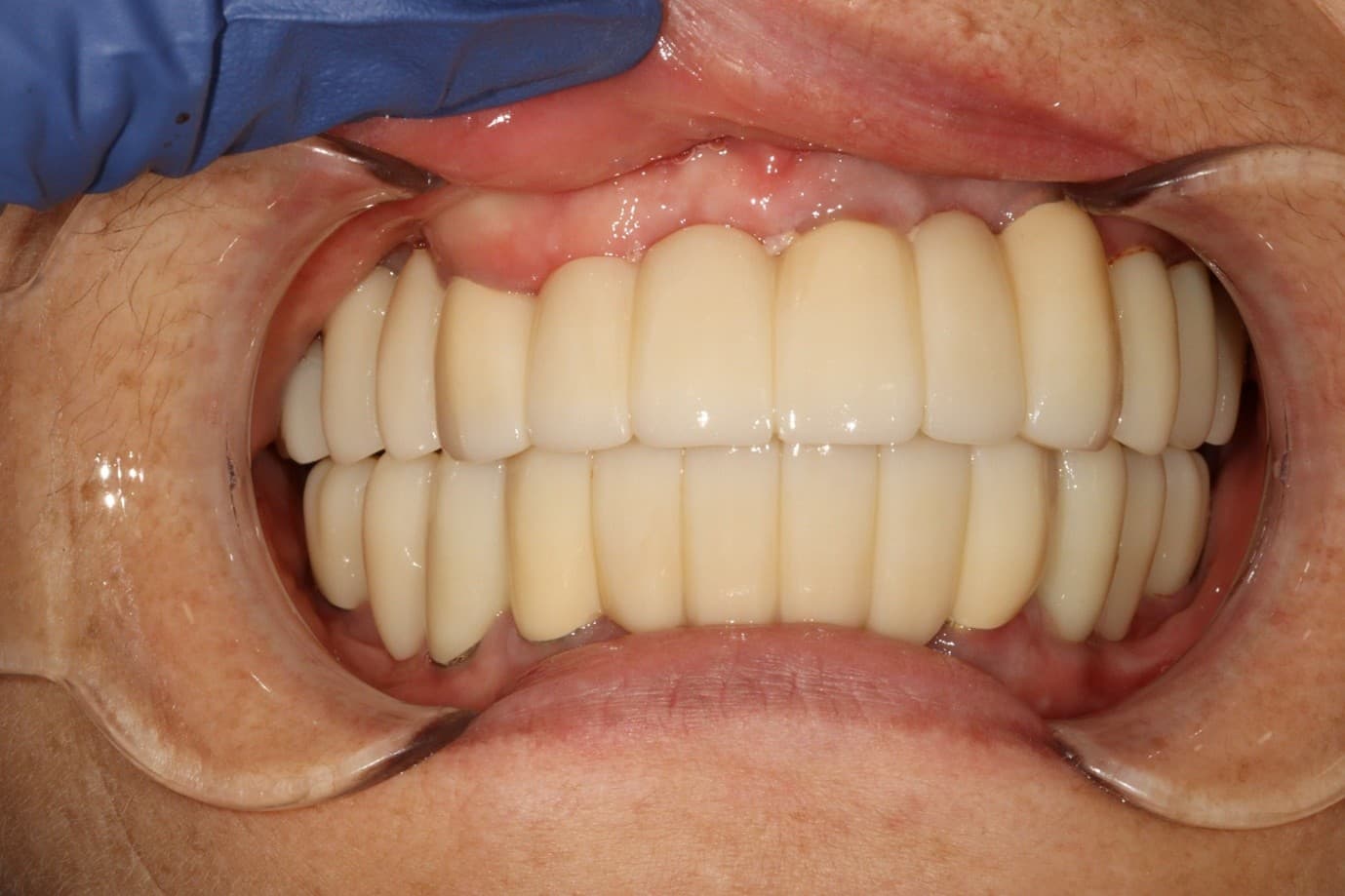 구강 사진 치료 후