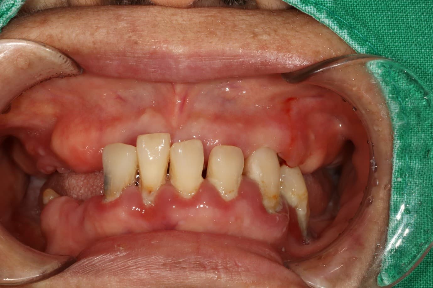 구강 사진 치료 전