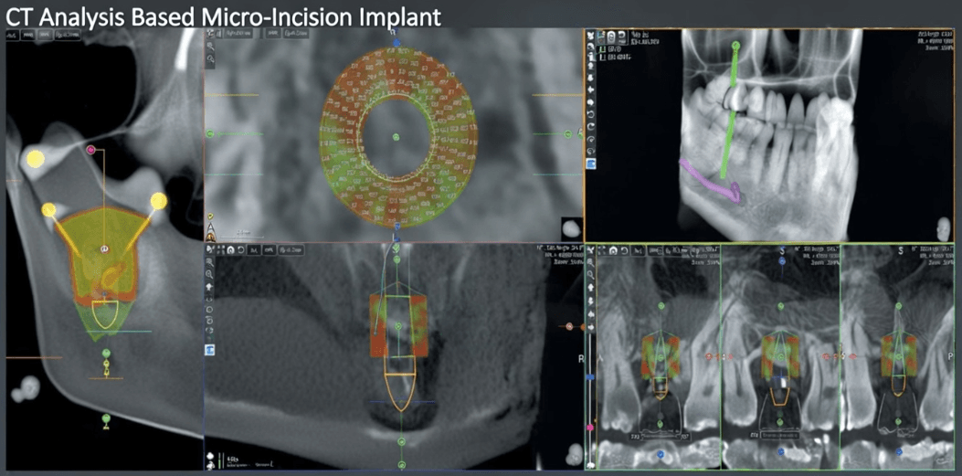 CT 파노라마 Eco-X Ai